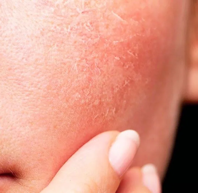 Tratamiento facial reset en la clínica